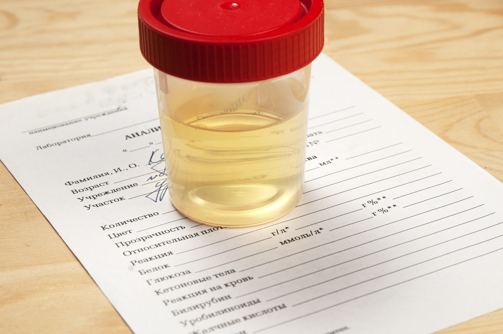 Medical examination of urine in a plastic glass