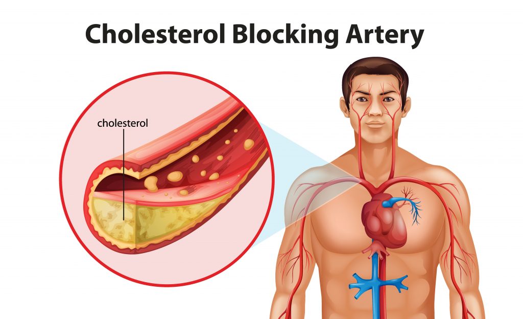 Illustration showing the process of ateriosclerosis