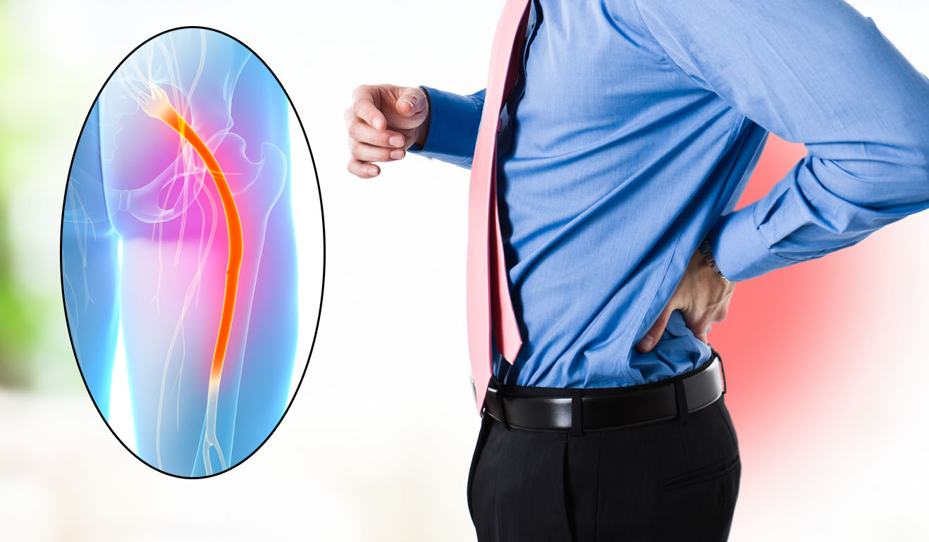 Home-Remedies-for-Sciatica