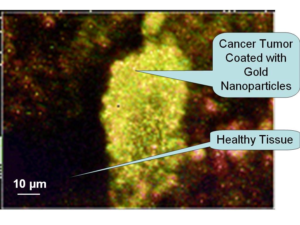 gold-cancer-cells