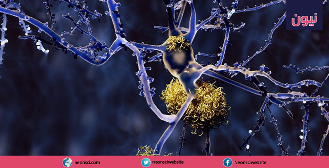 اكتشاف كتل بروتينية في المخ يُمكنها تحديد أنواع من ألزهايمر